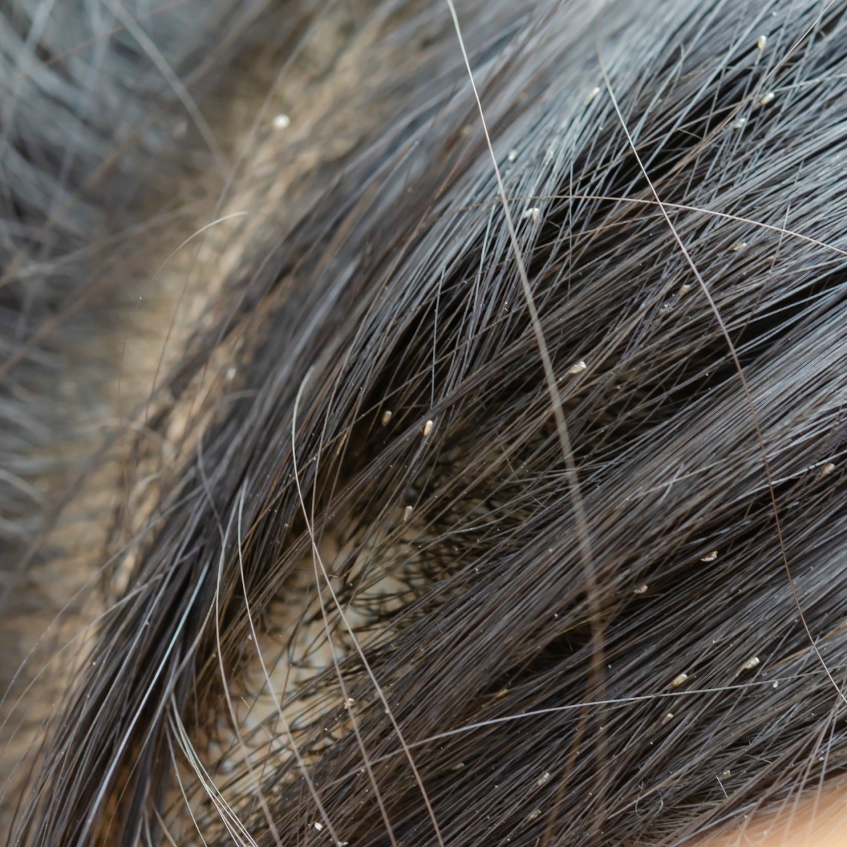 Getting Rid of Bugs in Hair | ThriftyFun