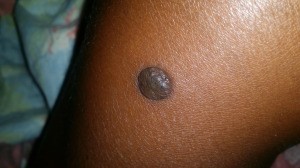 Getting Rid of Seed Warts - round cluster of warts