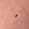 Identifying Small Brown Bugs - bug on skin