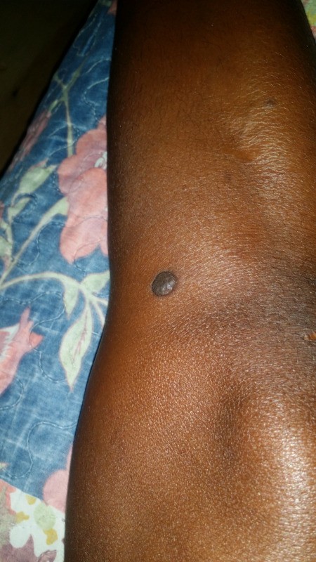 Removing a Seed Wart - round wart