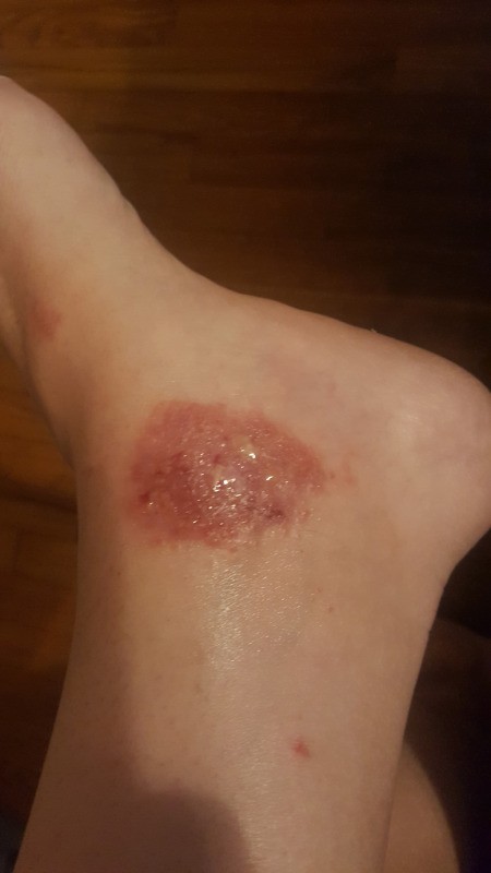 Treating a Rash on My Ankle - oozing rash on left ankle