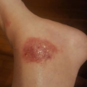 Treating a Rash on My Ankle - oozing rash on left ankle
