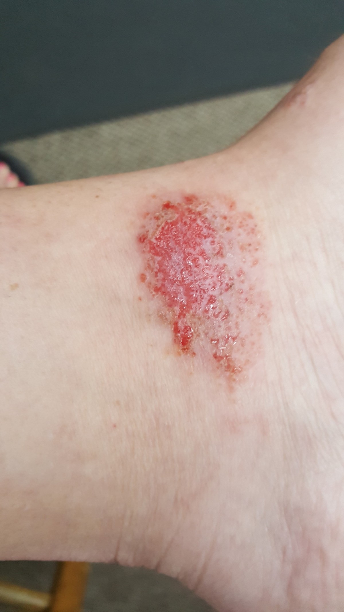 Red Itchy Patch On Ankle