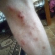 Identifying Tiny Burrowing Biting Black Bugs - red bites on leg