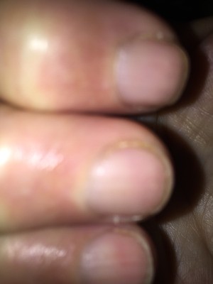 Remedy for Brittle Splitting Nails - closeup of nails