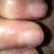 Remedy for Brittle Splitting Nails - closeup of nails