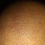 Identifying Tiny Black Biting Bugs - tiny black dot sized bug on skin