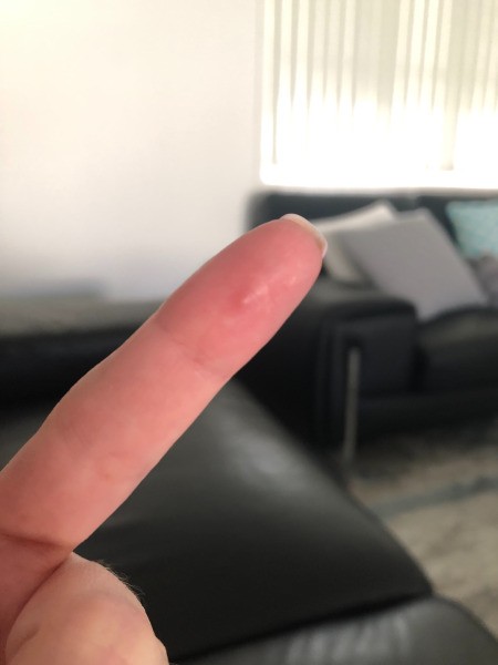 Identifying a Painful Bump on Finger Pad - pimple looking bump on index finger pad