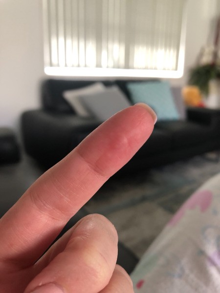 Small White Painful Dot On Finger