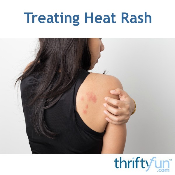 treating-heat-rash-thriftyfun