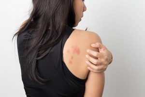 A woman with a rash on her arms and back.