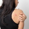 A woman with a rash on her arms and back.