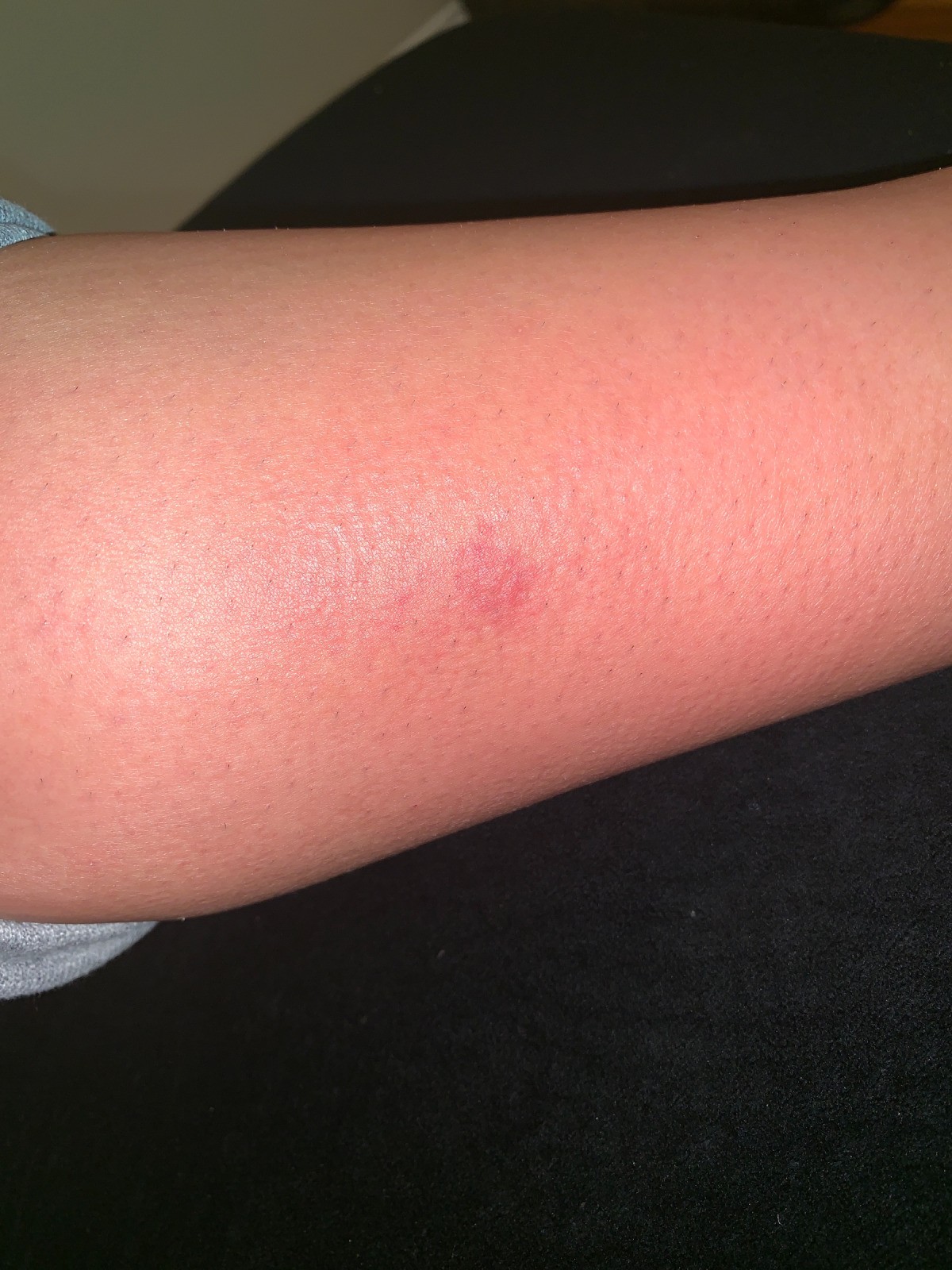 bug bites that itch in evening