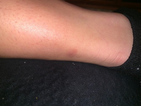 Identifying Bug Bites