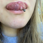 Bump After Tongue Piercing