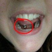 Is My Tongue Piercing Infected?
