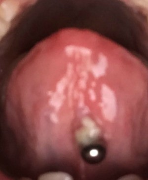White Pus Spot by Tongue Piercing