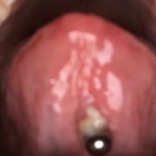 White Pus Spot by Tongue Piercing