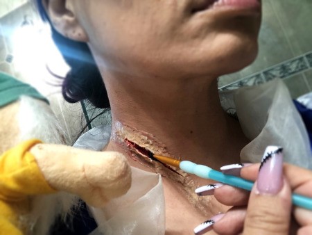 Snow White and the Undead Dwarves - remove dwarf and add fake blood to the wound