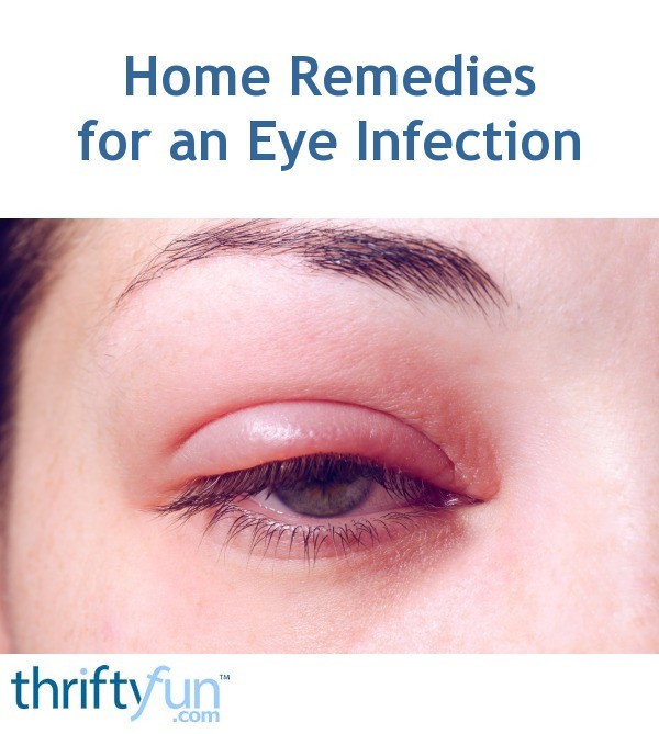 Home Remedies for an Eye Infection? | ThriftyFun