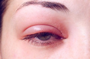 An eye infection.