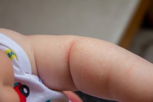 Baby's arm with prickly heat rash in fold of arm.