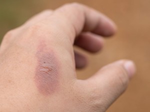 A hand with a minor burn.