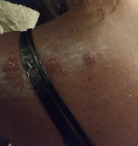 Getting Rid of Tiny Biting Bugs