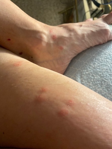 Unknown Bug Bites - red welts on feet and legs