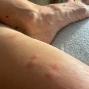 Unknown Bug Bites - red welts on feet and legs