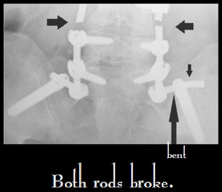 An x-ray of broken medical hardware.