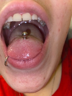 A tongue piercing with a white bump.