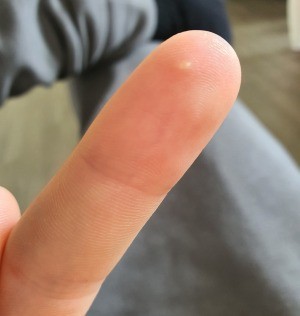 Identifying a Painful White Spot on My Finger - small white spot near the tip of a finger