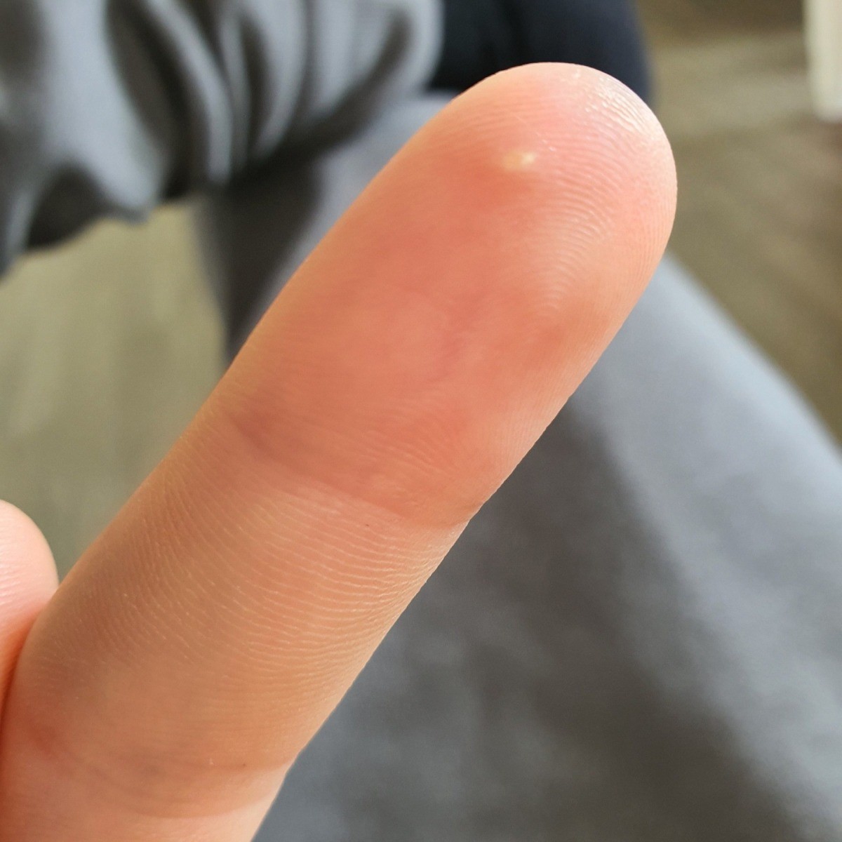 What Does It Mean When You Have A Red Spot On Your Finger