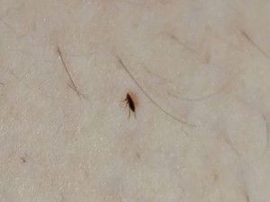 Getting Rid of Tiny Flying Biting Insects - tiny bug on a person's skin