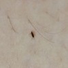 Getting Rid of Tiny Flying Biting Insects - tiny bug on a person's skin