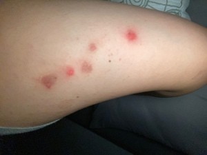 Bugs Biting Me in My Sleep - red insect or spider bites
