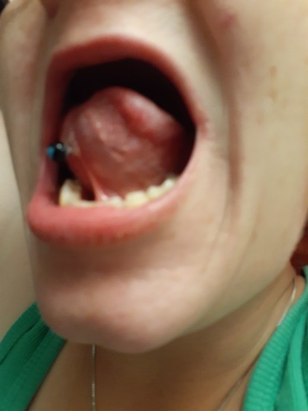 Problems with Tongue Piercing - view of the piercing