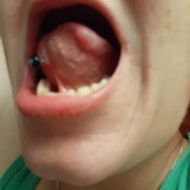 Problems with Tongue Piercing - view of the piercing