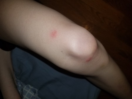 Anyone Know What Bit Me? - bites