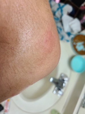 A red mark on a person's arm.