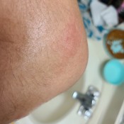 A red mark on a person's arm.