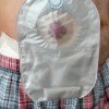 A stoma bag on a person's side.