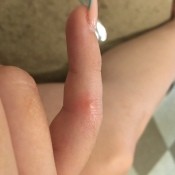 A red mark on a finger.