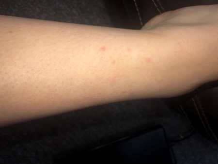 Bug bites on an arm.