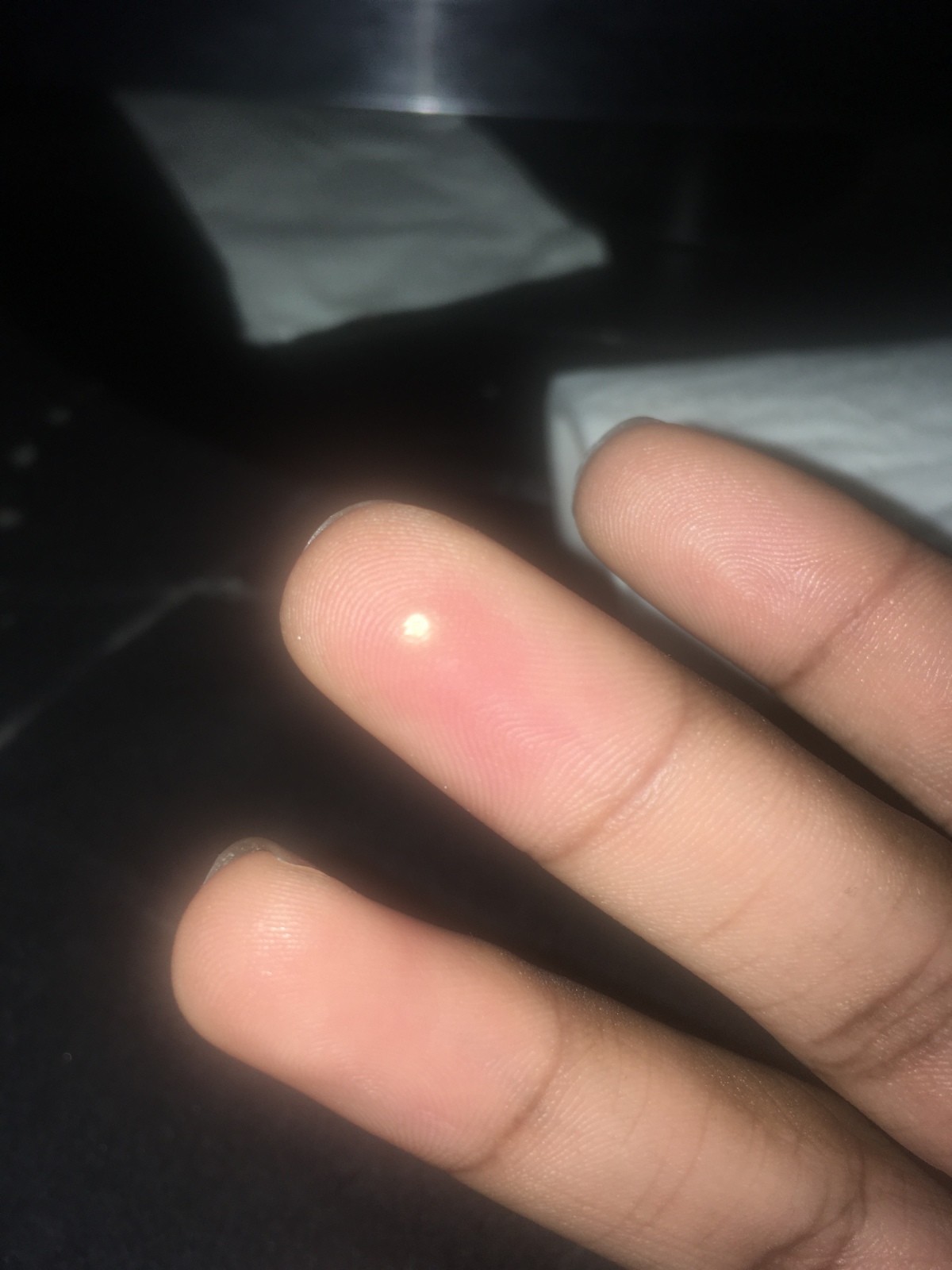 identifying-a-painful-white-spot-on-my-finger-thriftyfun