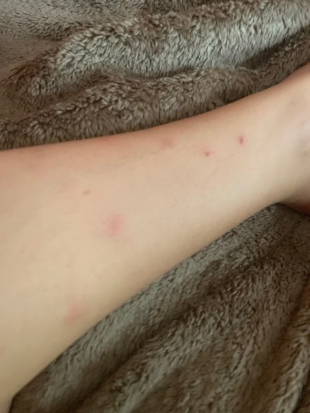 Red bite marks on an arm.