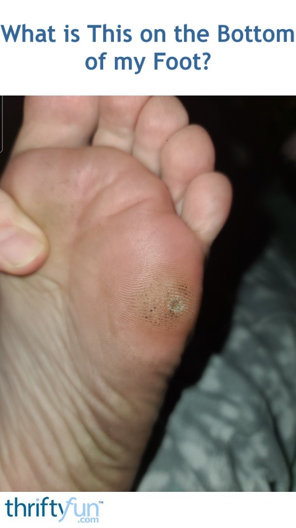 What is This on the Bottom of my Foot? ThriftyFun