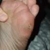 A sore or marking on the bottom of a foot.