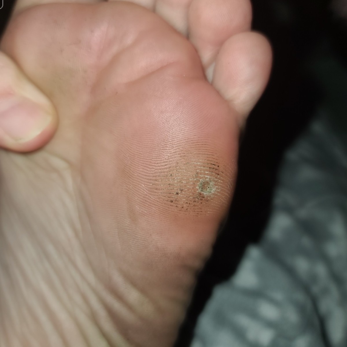 What Causes Pain At The Bottom Of My Feet